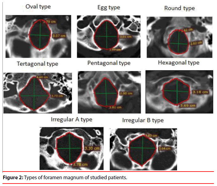 Morphometric Evaluation Of Foramen Magnum By Using Computerized Tomographic Images 3535