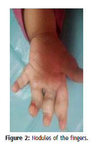 clinical-rheumatology-Nodules