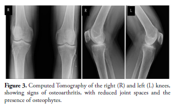 clinical-rheumatology-osteoarthritis