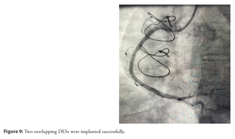 interventional-cardiolog-DESs