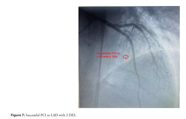 interventional-cardiolog-LAD