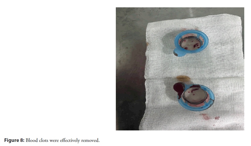 interventional-cardiolog-clots