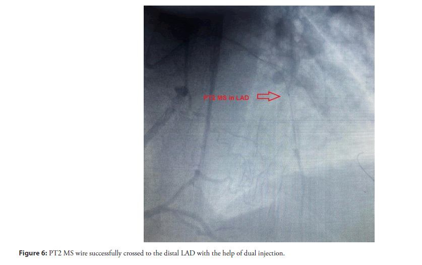 interventional-cardiolog-distal