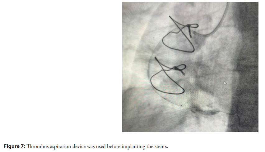 interventional-cardiolog-implanting