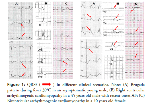 interventional-cardiology-asymptomatic