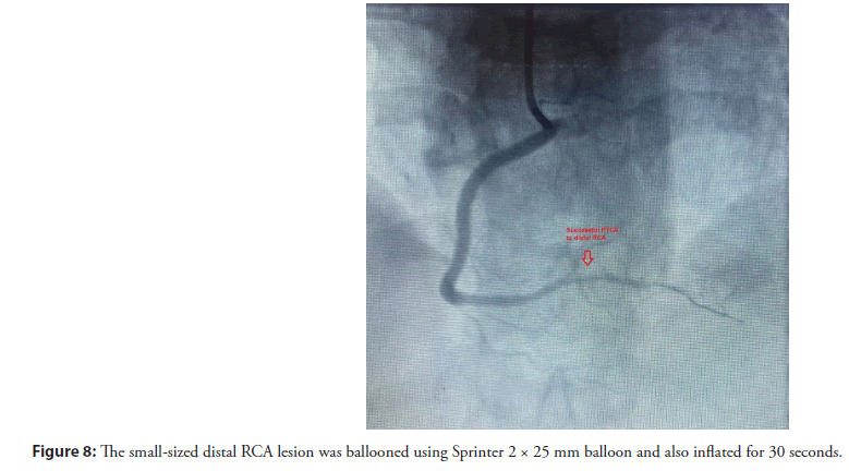 interventional-cardiology-ballooned