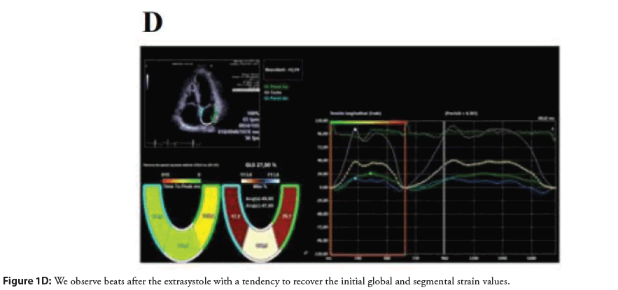 interventional-cardiology-extrasystole