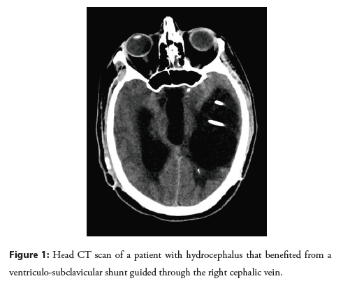 interventional-cardiology-hydrocephalus