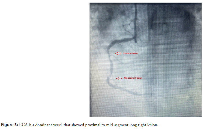 interventional-cardiology-lesion