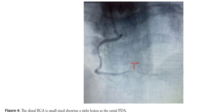 interventional-cardiology-ostial