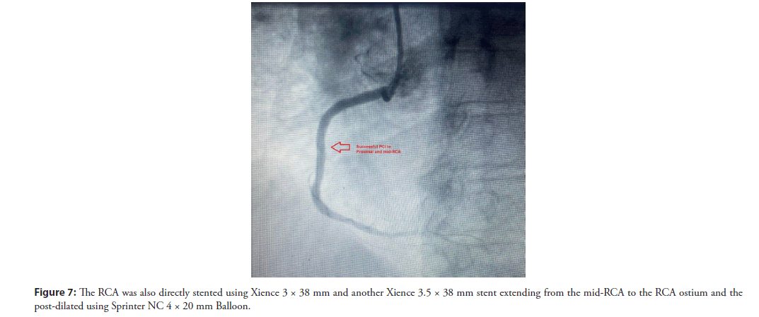 interventional-cardiology-ostium