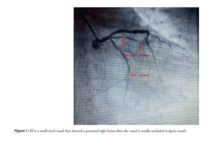 interventional-cardiology-proximal