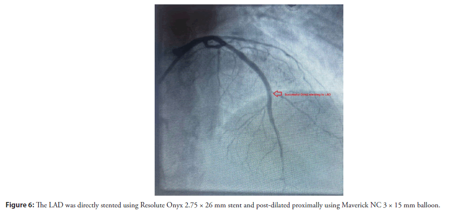 interventional-cardiology-stented