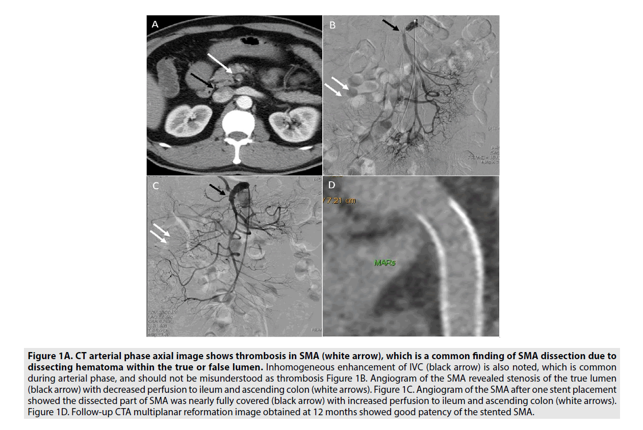 Imaging-Med-dissecting-hematoma