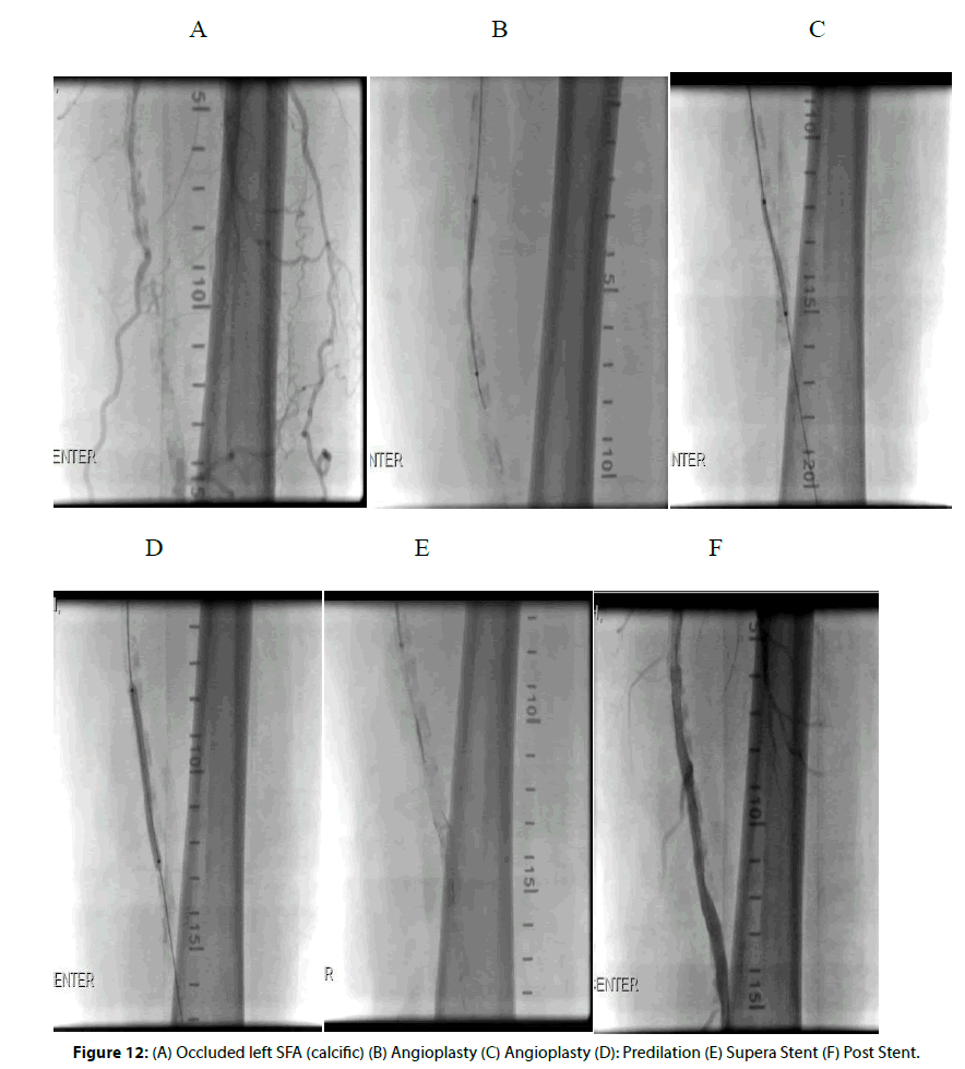 Interventional-Cardiology-Post-Supera