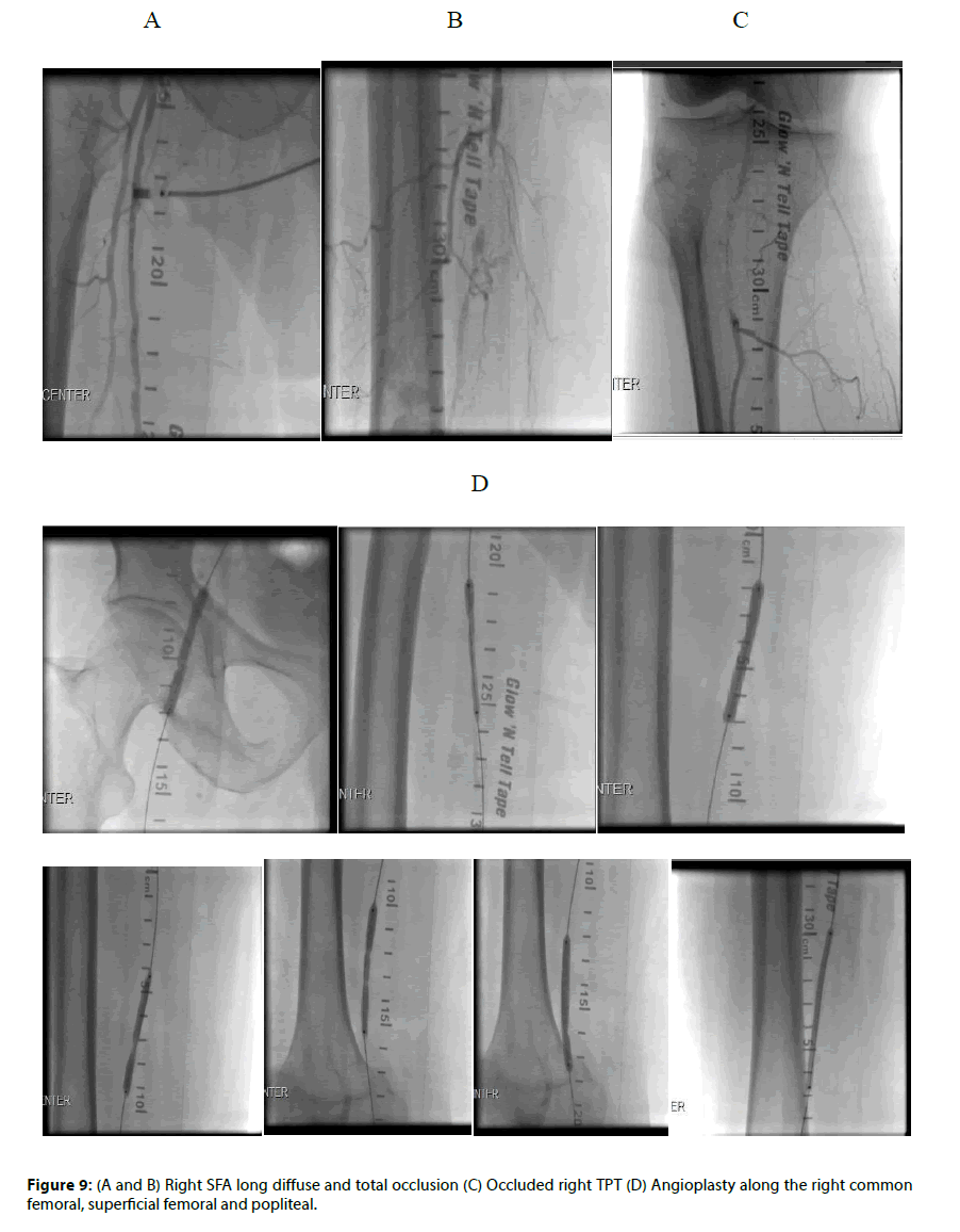 Interventional-Cardiology-occlusion