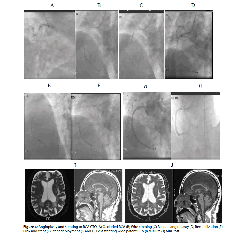 Interventional-Cardiology-prox-mid