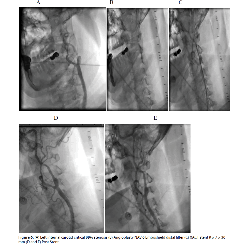 Interventional-Cardiology-stenosis