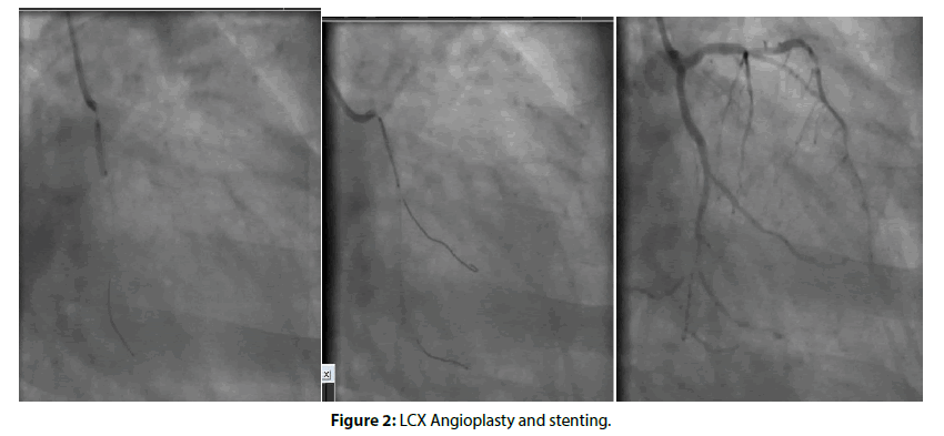 Interventional-Cardiology-stenting