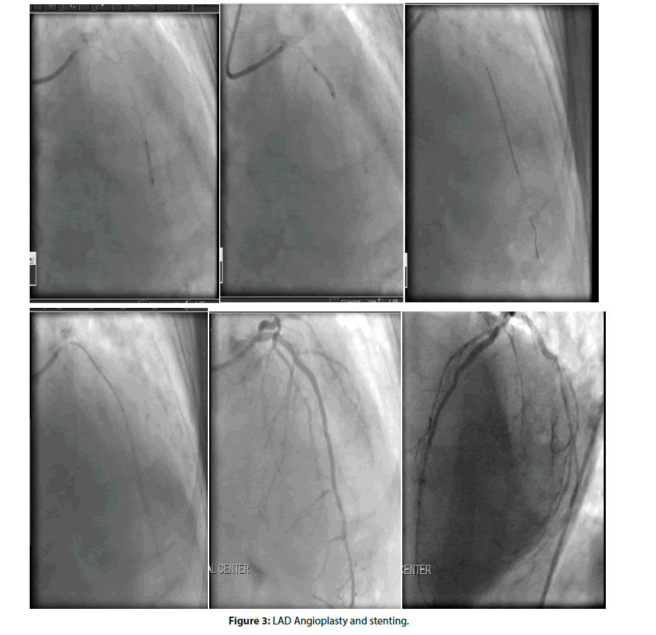 Interventional-Cardiology-stenting-angioplasty