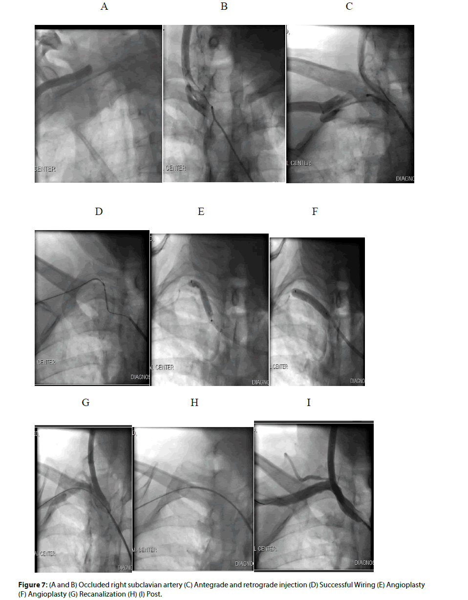 Interventional-Cardiology-subclavian