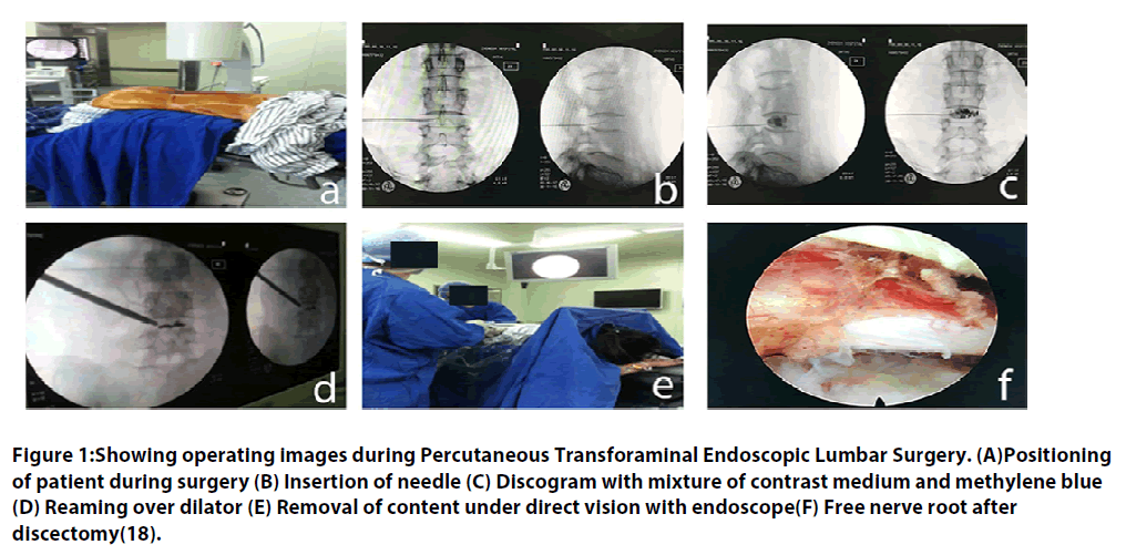 clinical-practice-Transforaminal-Endoscopic