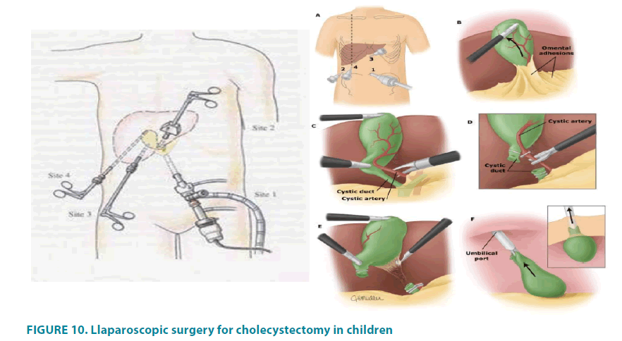 clinical-practice-cholecystectomy-children