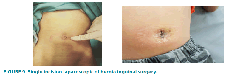 clinical-practice-hernia-inguinal