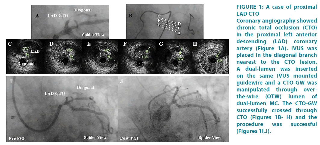 clinical-practice-same-IVUS-mounted