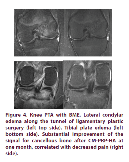 clinical-rheumatology-cancellous-bone