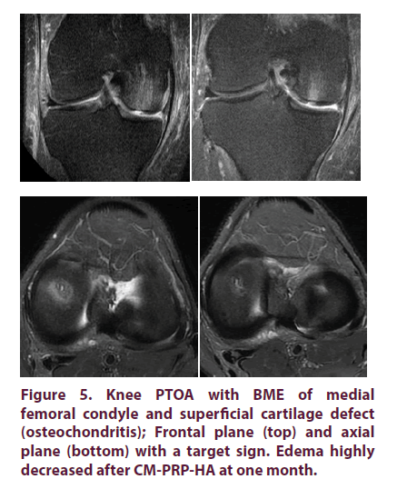 clinical-rheumatology-cartilage-defect