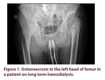 clinical-rheumatology-hemodialysis