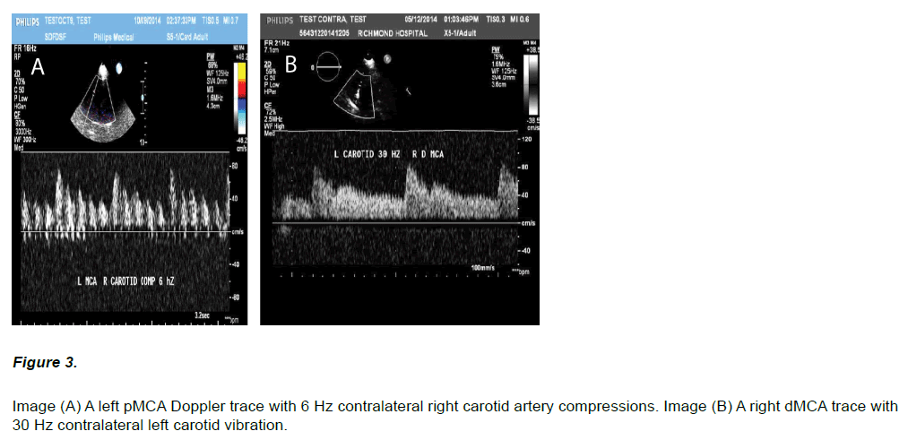 experimental-stroke-translational-medicine-artery-compressions