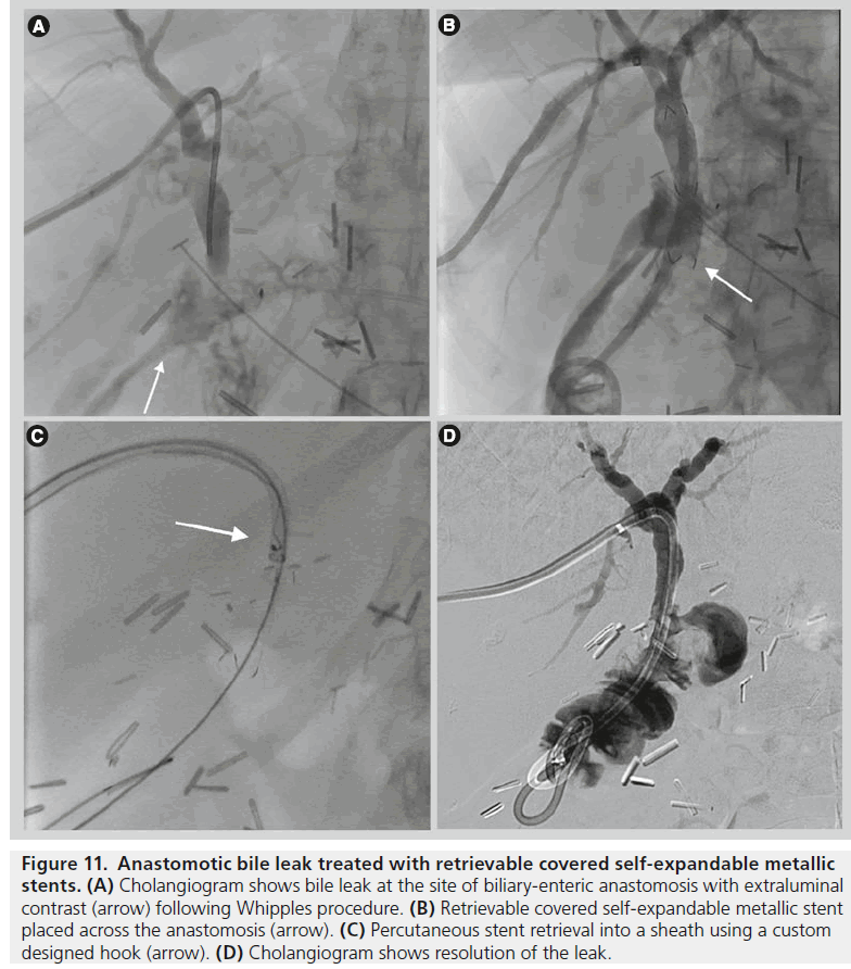 imaging-in-medicine-Anastomotic-bile