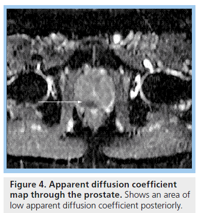 imaging-in-medicine-Apparent-diffusion