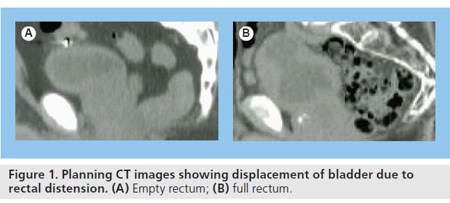 imaging-in-medicine-Empty-rectum