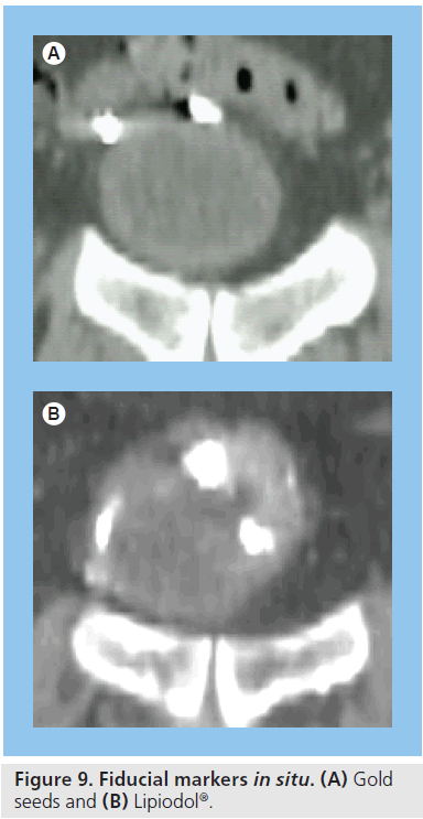 imaging-in-medicine-Gold-seeds