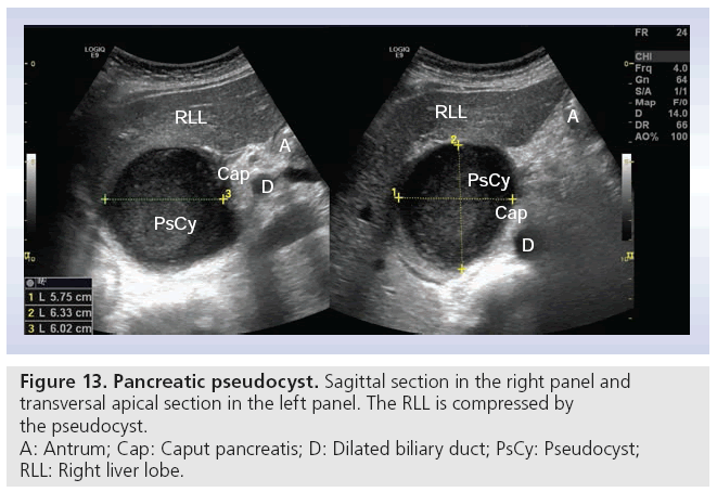 imaging-in-medicine-Pancreatic-pseudocyst