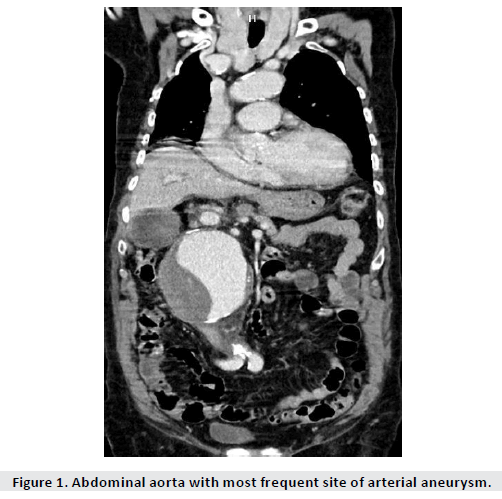 imaging-in-medicine-arterial-aneurysm