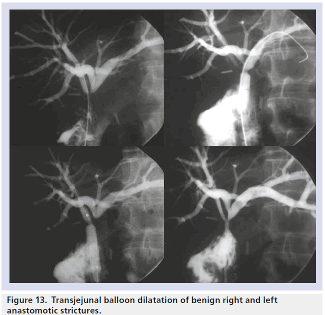 imaging-in-medicine-balloon-dilatation