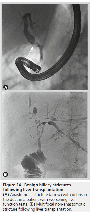 imaging-in-medicine-biliary-strictures