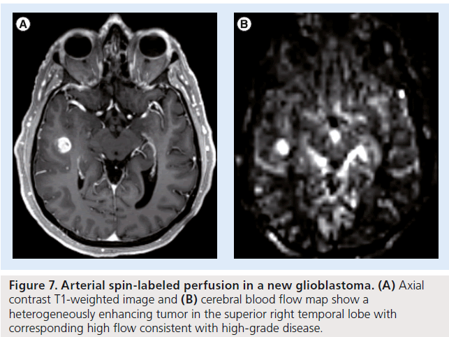 Role of MRI perfusion in improving the treatment of brain tumors