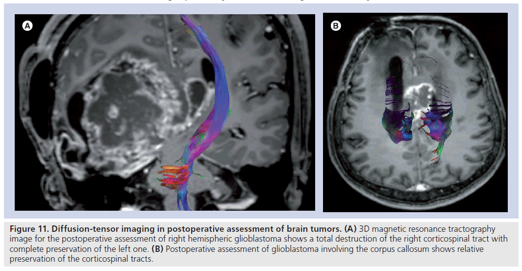 imaging-in-medicine-brain-tumor