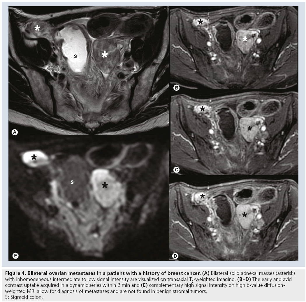 MRI In Ovarian Cancer