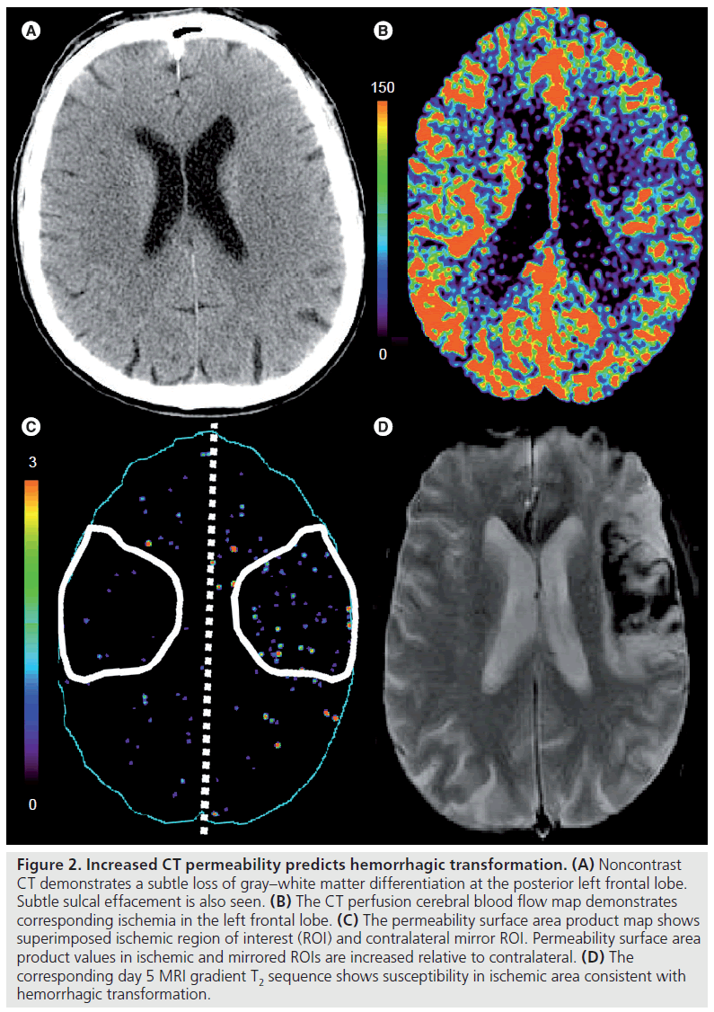 Current advances in CT imaging of stroke