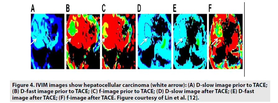 imaging-in-medicine-hepatocellular-carcinoma