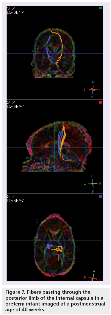 imaging-in-medicine-internal-capsule