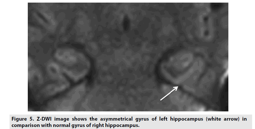 imaging-in-medicine-left-hippocampus