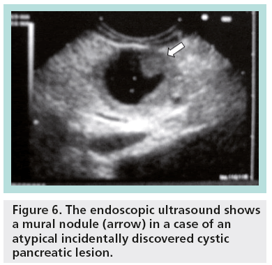 Managing Incidental Cystic Lesions In Pancreatic Imaging Challe   Imaging In Medicine Mural Nodule 5 2 127 G006 