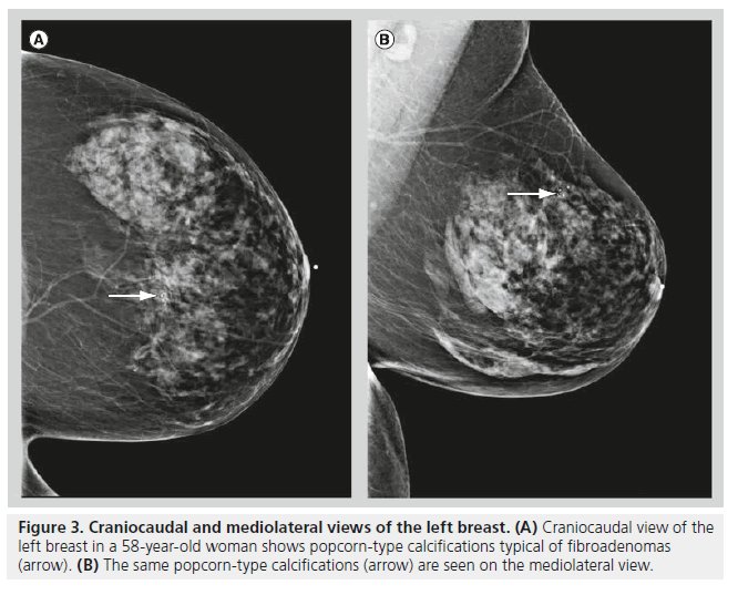 Mammography Of Breast Calcifications